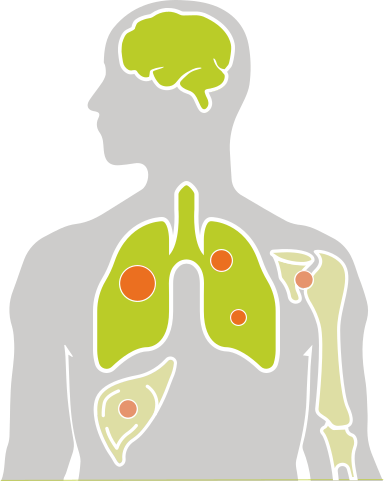 Illustration of patient highlighting all locations where cancer can spread, including the liver, lungs, bone, and brain.